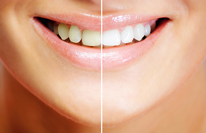 ホワイトニング